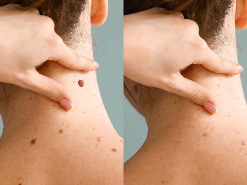 Moles & Warts Treatment in Siliguri